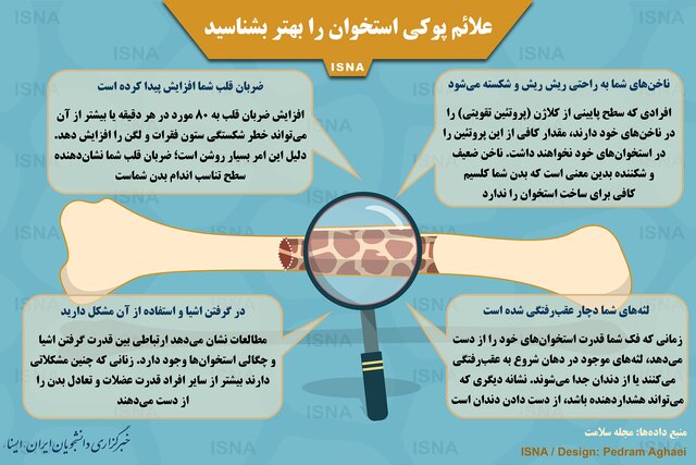 (تصویر) علائم اصلی پوکی استخوان