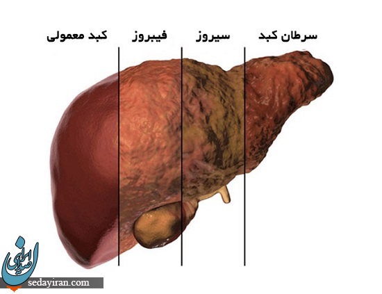 تشخیص بیماری‌های کبدی در مراحل ابتدایی