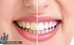 برای داشتن دندانی زیبا، هزینه نکنید