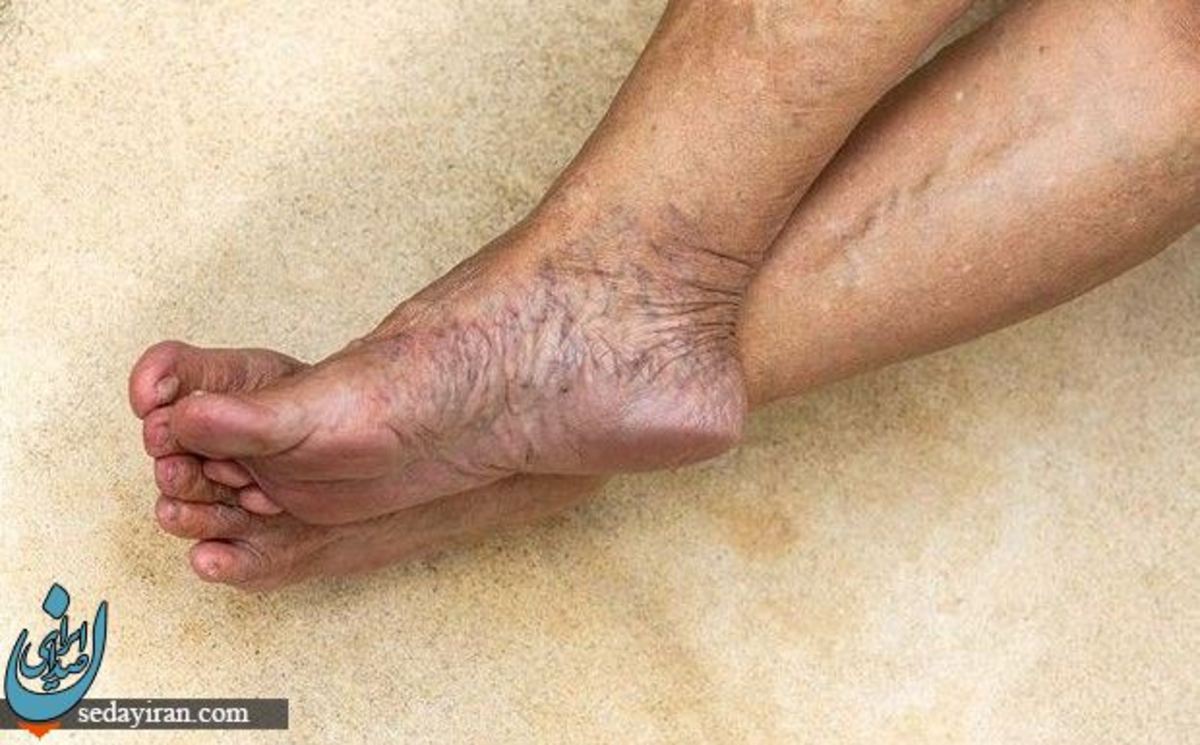 روش های مختلف درمان واریس پا