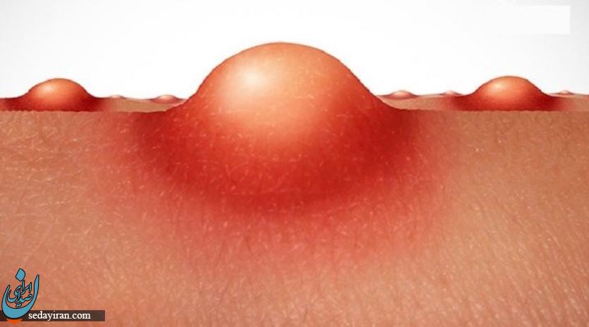 تفاوت زگیل تناسلی با جوش مقعدی چیست؟ + روشهای درمان