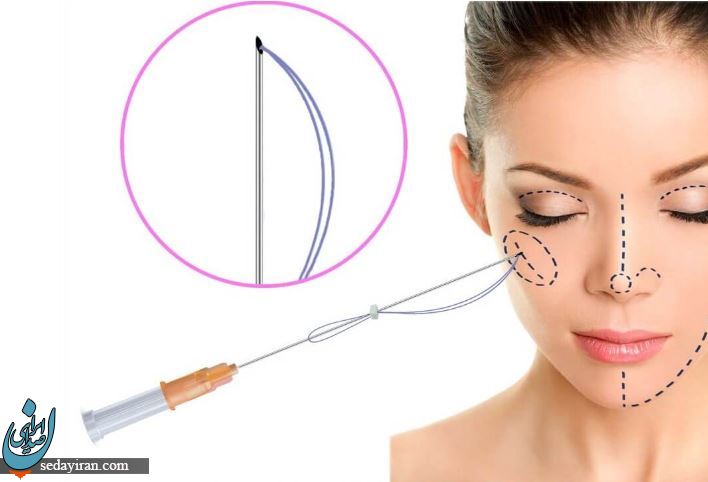 لیفت گونه با نخ چه مزایا و عوارضی دارد؟