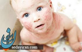 بیماری سلیاک چیست و چه علائمی دارد؟