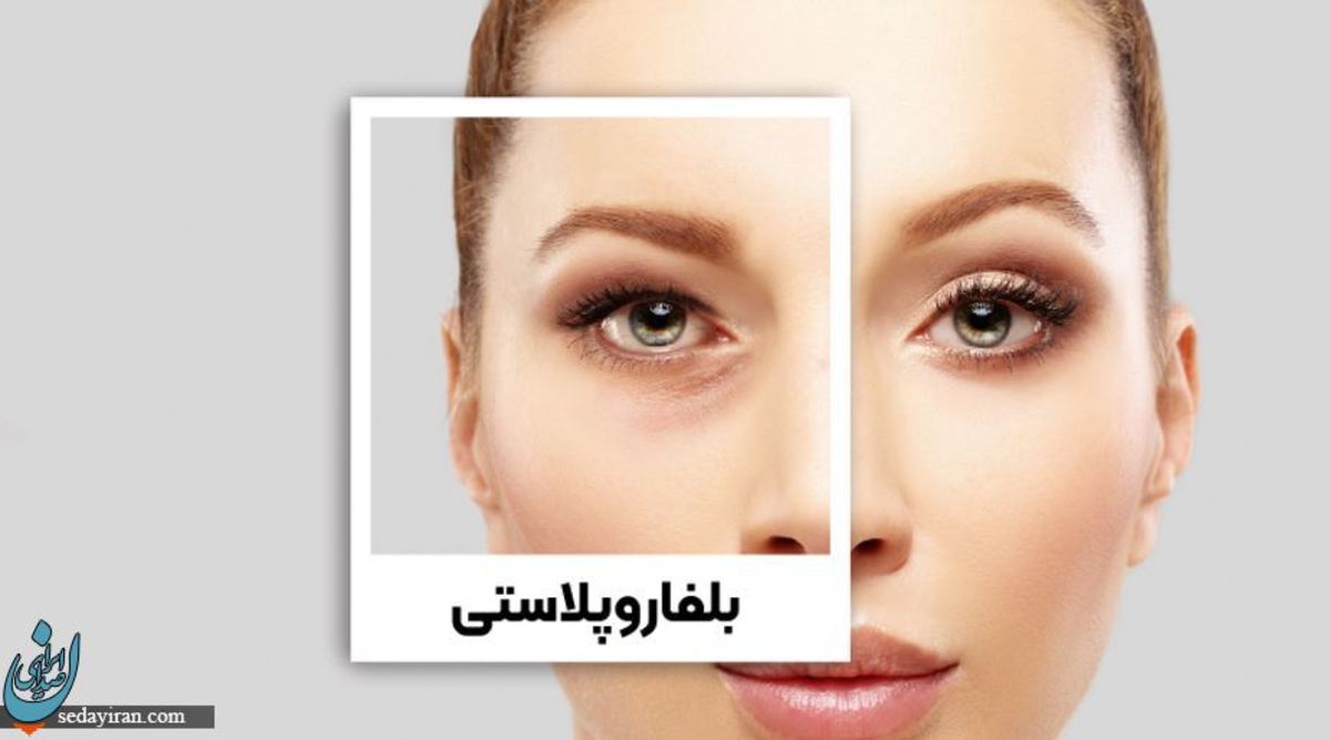 بلفاروپلاستی پلک پایین چیست ؟ + خطرات و هزینه