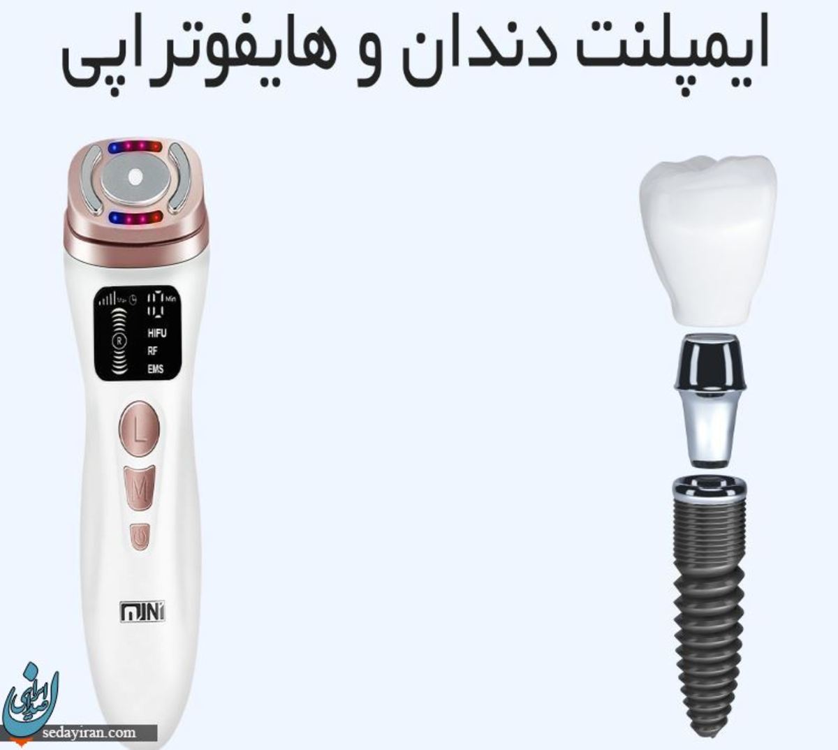 آیا ایمپلنت دندان و هایفوتراپی مانعی برای هم هستند؟