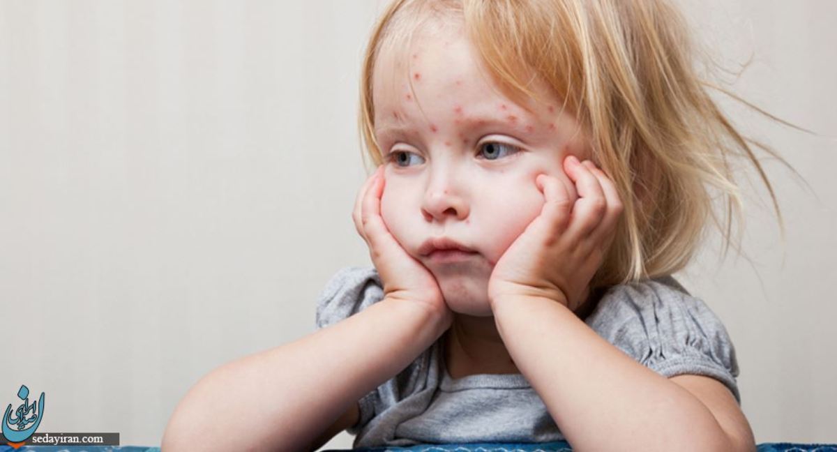 چگونه از سرایت آبله مرغان جلوگیری کنیم؟