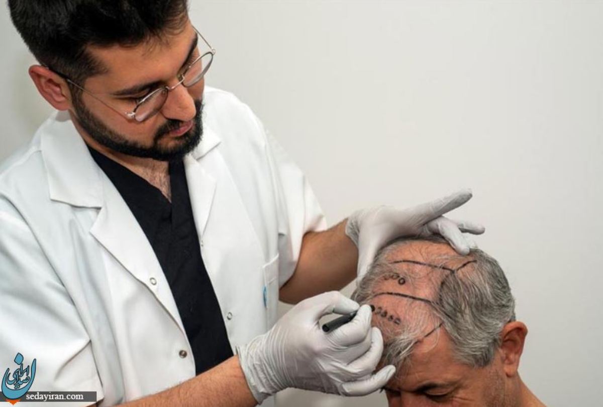 کاشت مو به روش ترکیبی چگونه انجام می شود؟