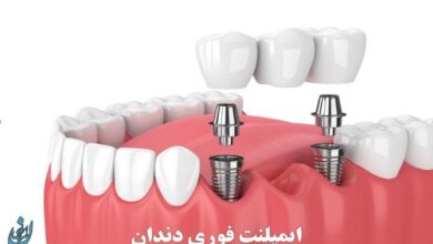 ایمپلنت فوری دندان