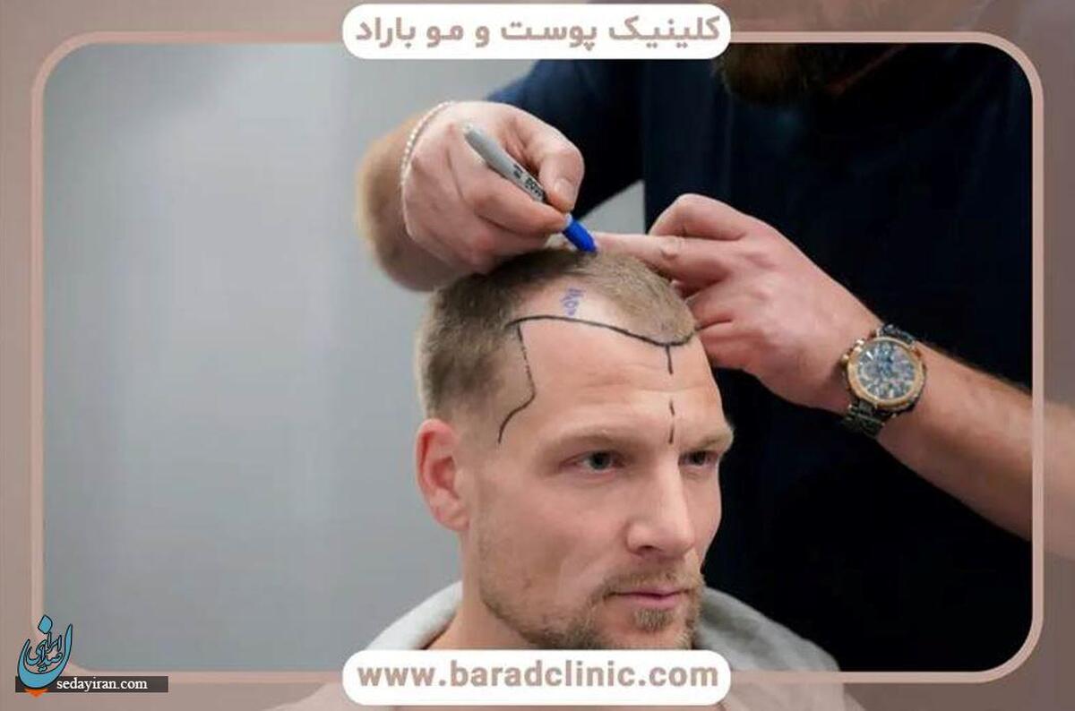 هزینه کاشت مو: همه چیز درباره عوامل تاثیرگذار و نحوه کاهش هزینهها